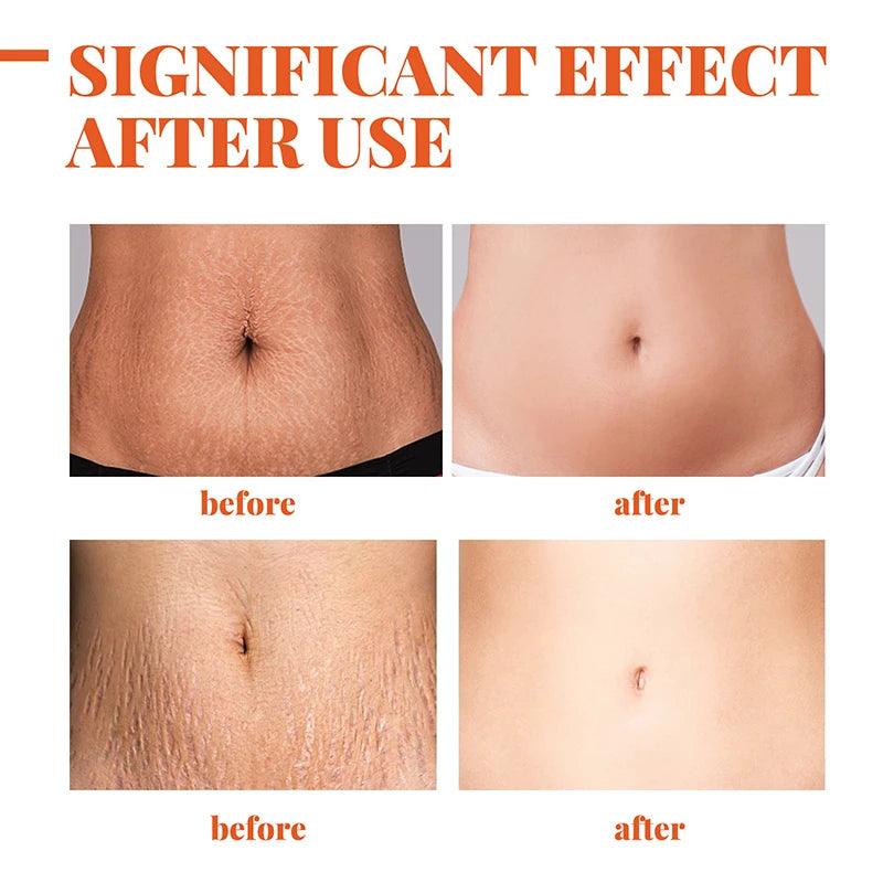 Maternity Scar Repair Essential Oil Pregnancy Lift Stretch Mark Remove Enhance Skin Care Elasticity Firm Sagging Deep Moisturize